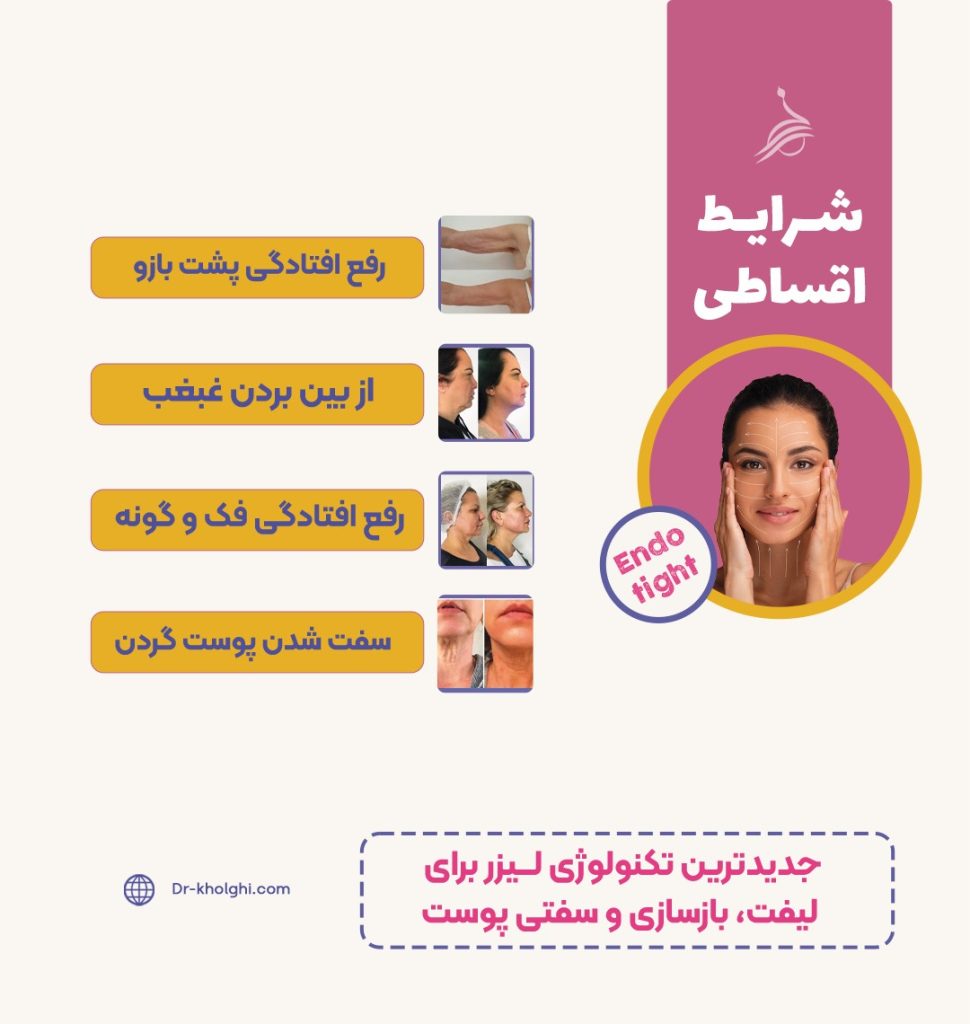 Endo Tight (اندوتایت)