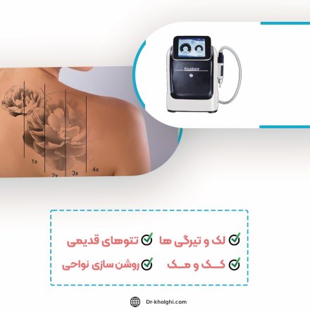 Q-Switch Laser (لیزر کیوسوئیچ)
