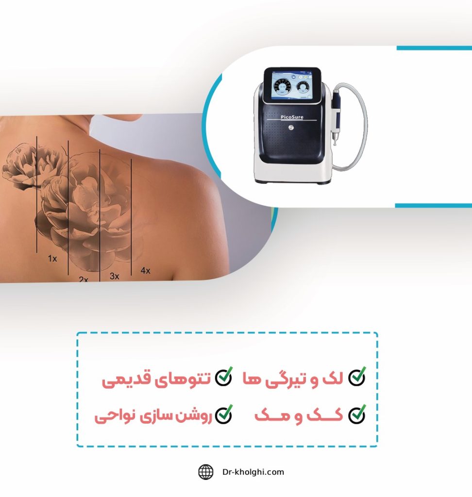 Q-Switch Laser (لیزر کیوسوئیچ)